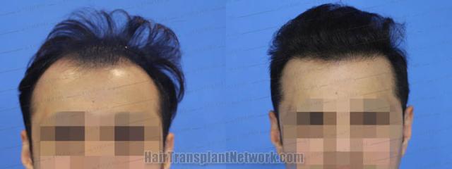   before and after result photographs