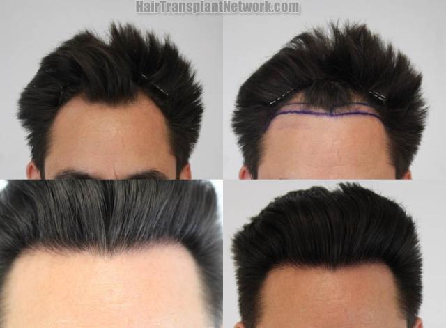 Front view - Before and after hair restoration procedure