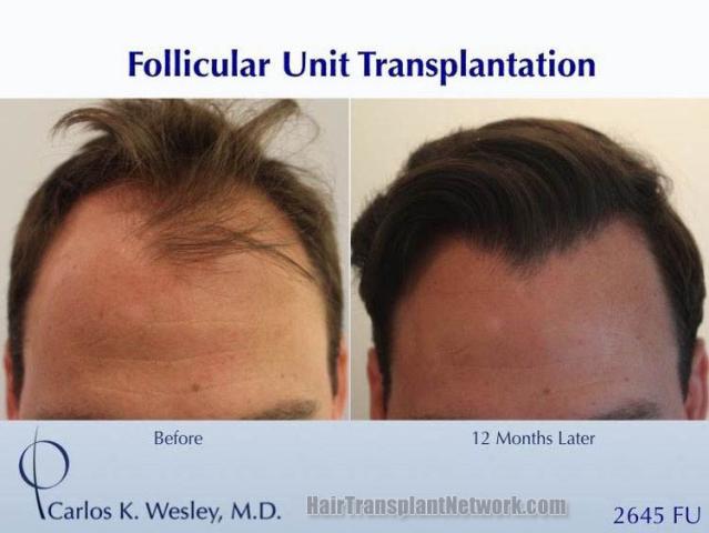 Front view - Before and after hair restoration procedure