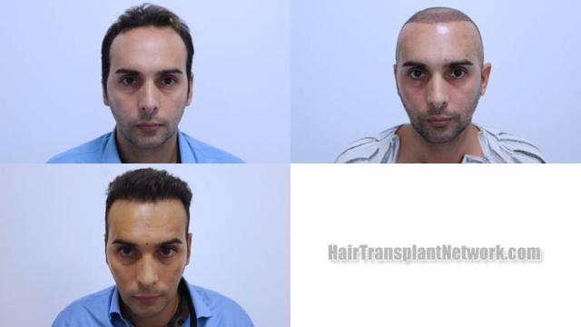 Front view - Before and after hair restoration procedure