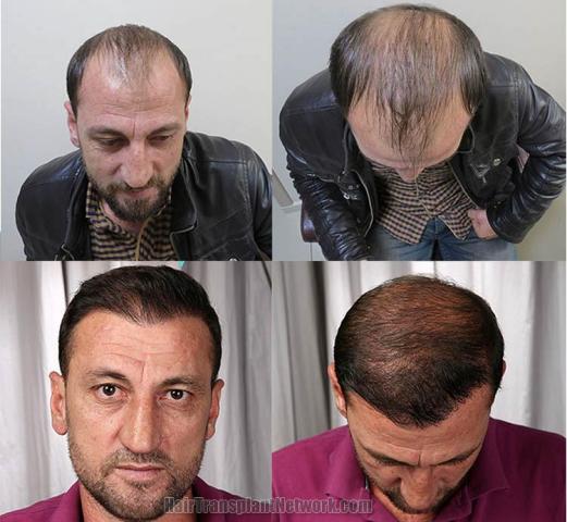 Hair restoration procedure before and after pictures