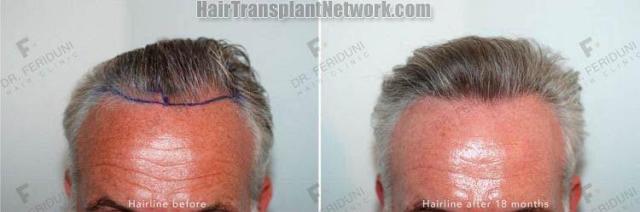 Hair transplantation surgery before and after images