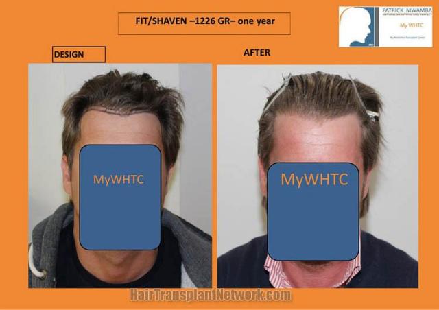 Hair transplantation surgery before and after photos