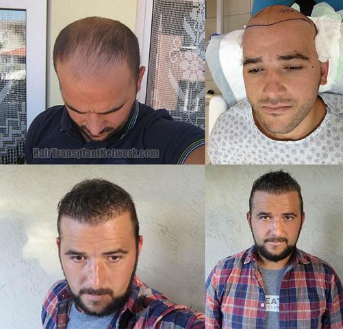 Hair transplantation surgery before and after photos