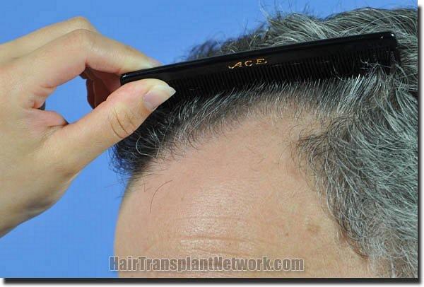 Hair restoration procedure results