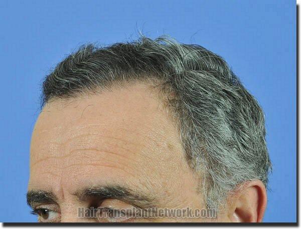 Hair restoration procedure results