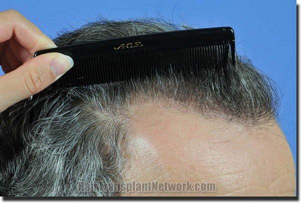 Hair restoration procedure results