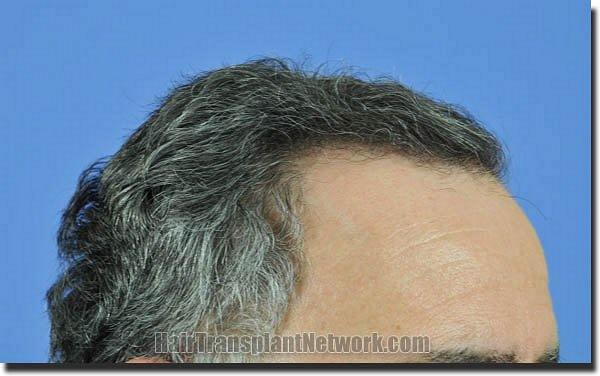 Hair restoration procedure results