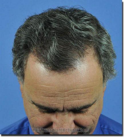 Hair restoration procedure results