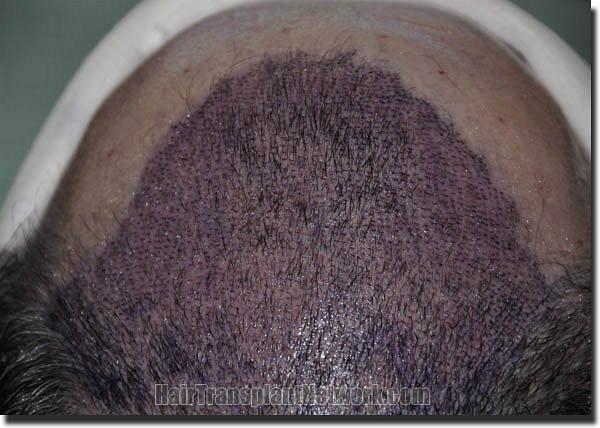 Hair restoration procedure results