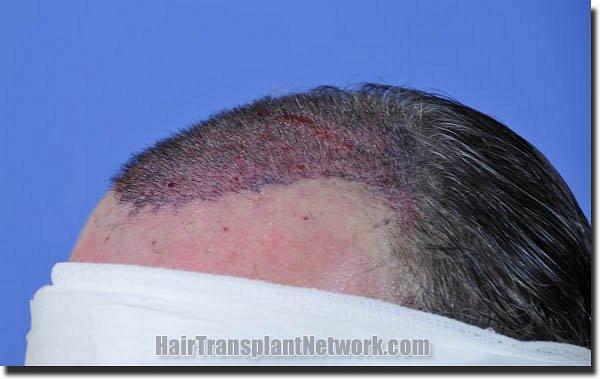 Hair restoration procedure results