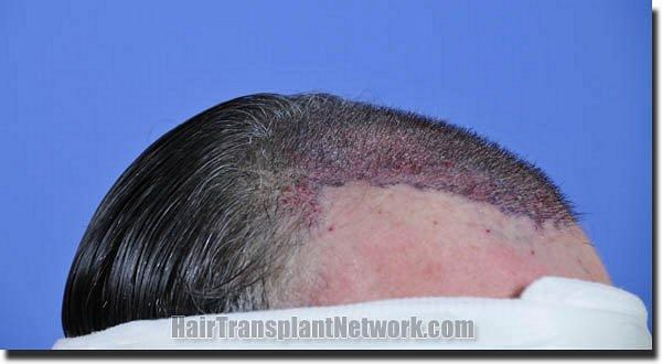 Hair restoration procedure results