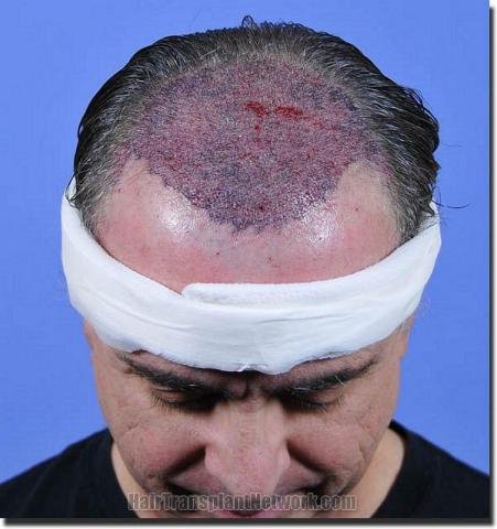 Hair restoration procedure results