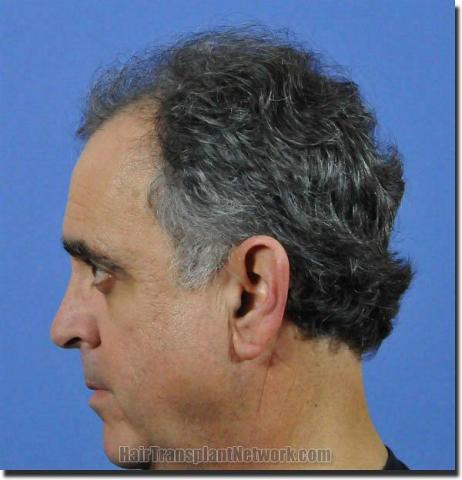 Hair restoration procedure results