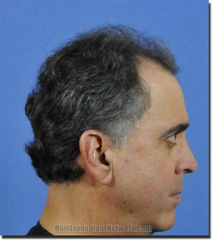 Hair restoration procedure results