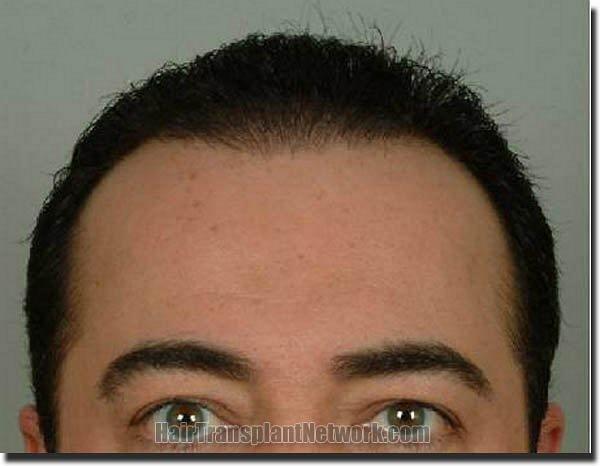 Hair restoration procedure results