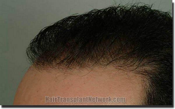 Hair restoration procedure results