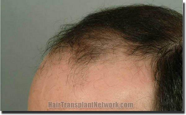 Hair restoration procedure results