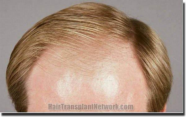 Hair restoration procedure results