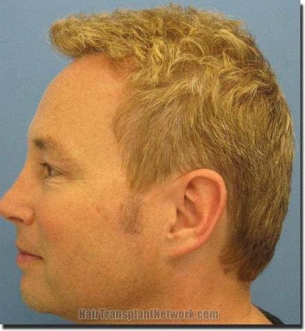 Hair restoration procedure results