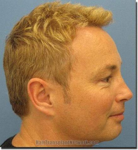 Hair restoration procedure results