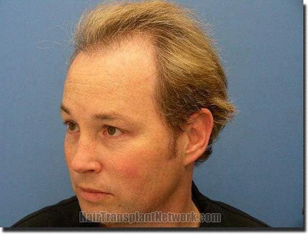 Hair restoration procedure results