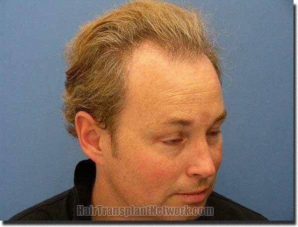 Hair restoration procedure results