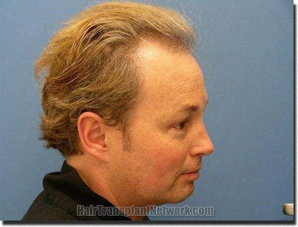 Hair restoration procedure results