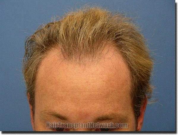 Hair restoration procedure results