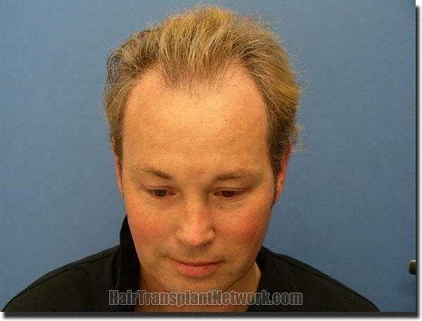 Hair restoration procedure results