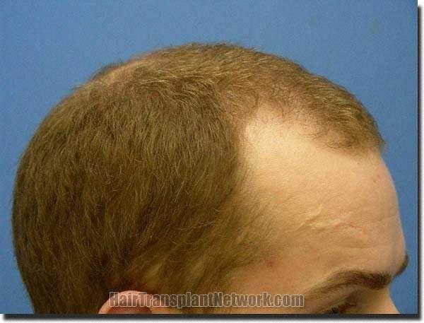 Hair restoration procedure results