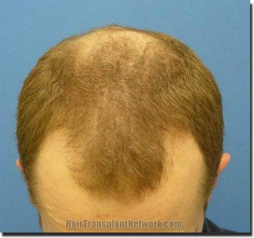 Hair restoration procedure results