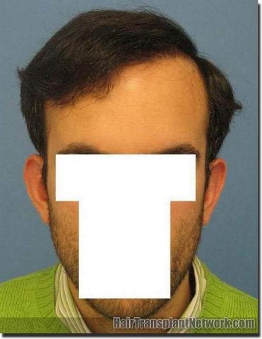 Hair restoration procedure results