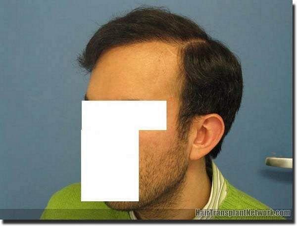 Hair restoration procedure results