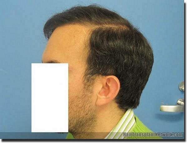 Hair restoration procedure results