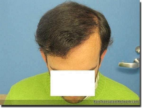 Hair restoration procedure results