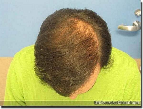 Hair restoration procedure results