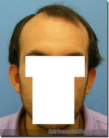 Hair restoration procedure results