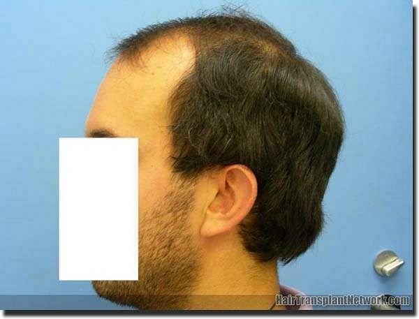 Hair restoration procedure results