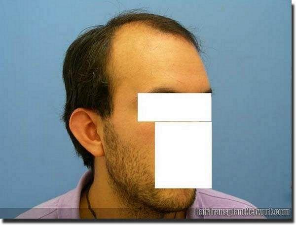 Hair restoration procedure results