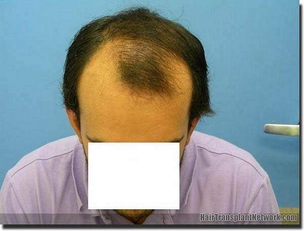 Hair restoration procedure results