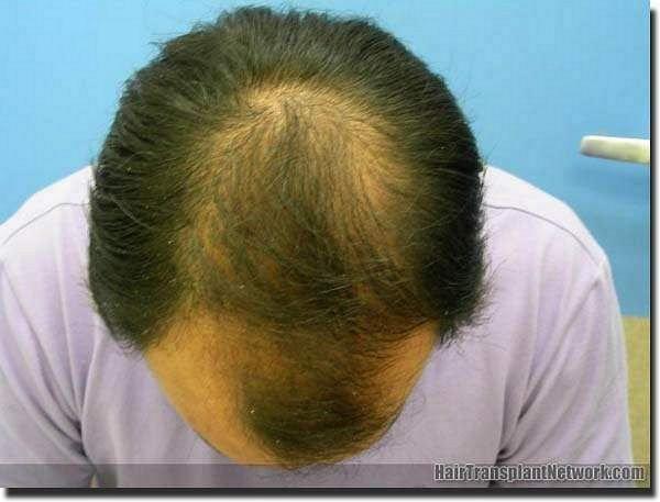 Hair restoration procedure results