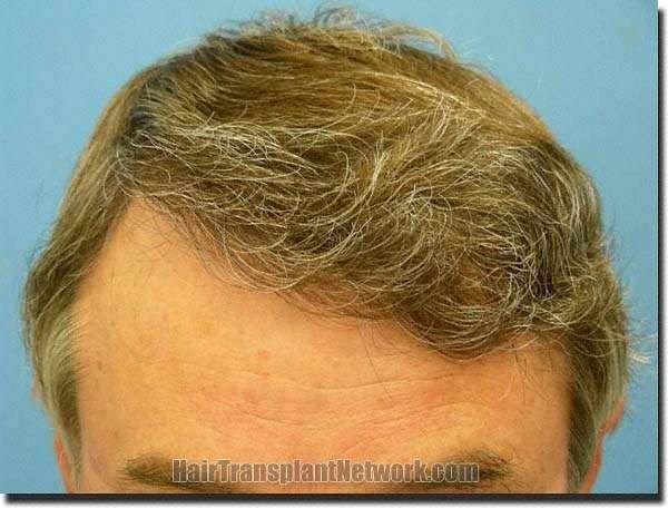 Hair restoration procedure results