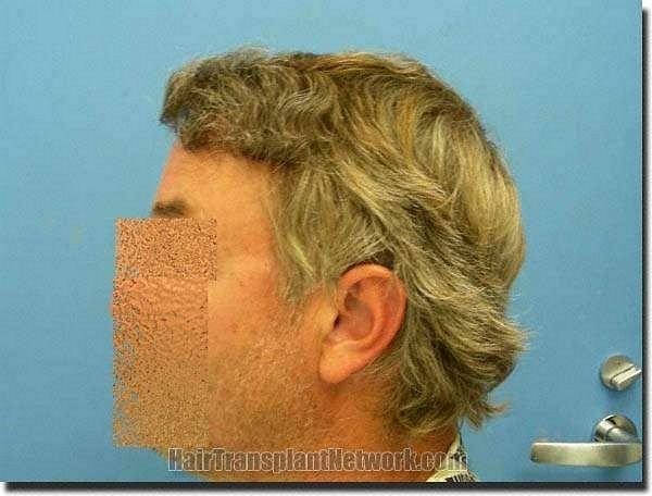 Hair restoration procedure results