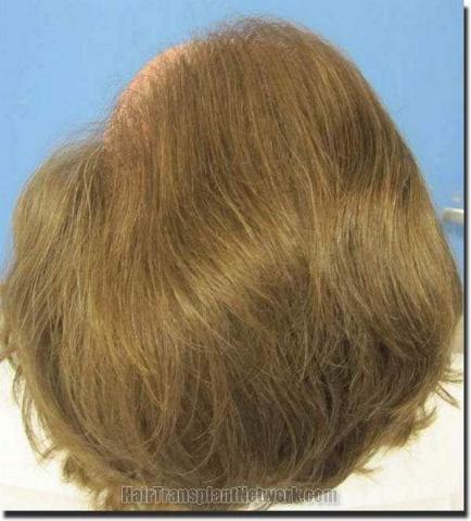 Hair restoration procedure results