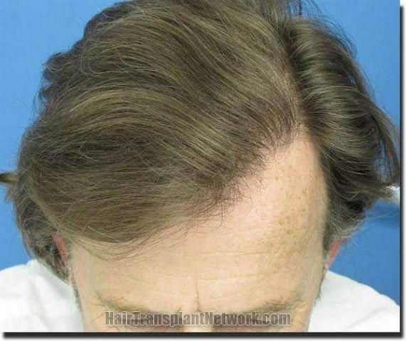 Hair restoration procedure results