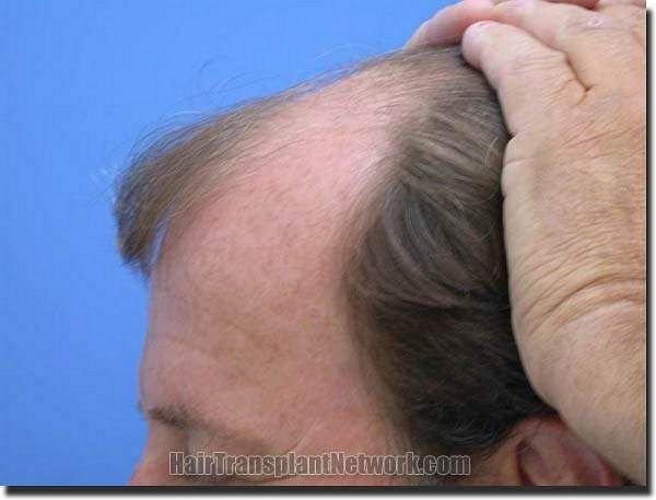 Hair restoration procedure results