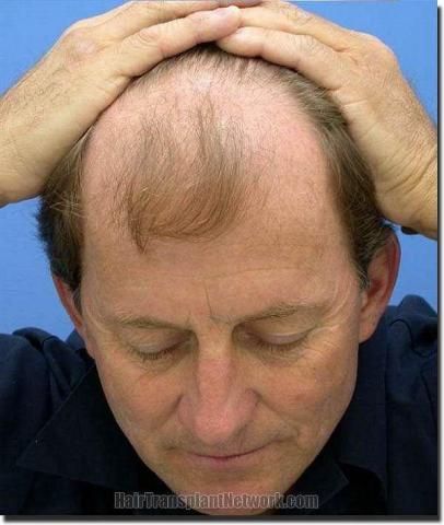 Hair restoration procedure results