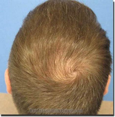 Hair restoration procedure results