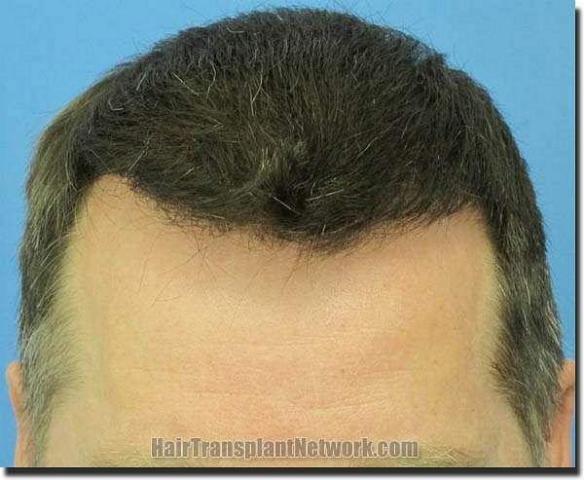 Hair restoration procedure results